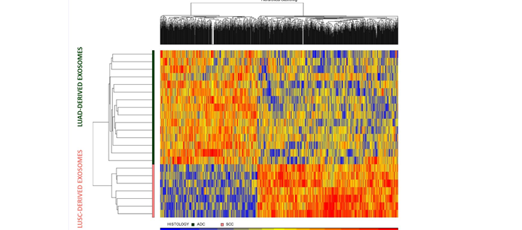 Buscan nuevos biomarcadores en vesículas extracelulares en cáncer de pulmón